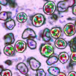 Measles Outbreak