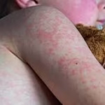 Measles Outbreaks In The U.s. 2025
