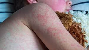 Measles Outbreaks In The U.s. 2025